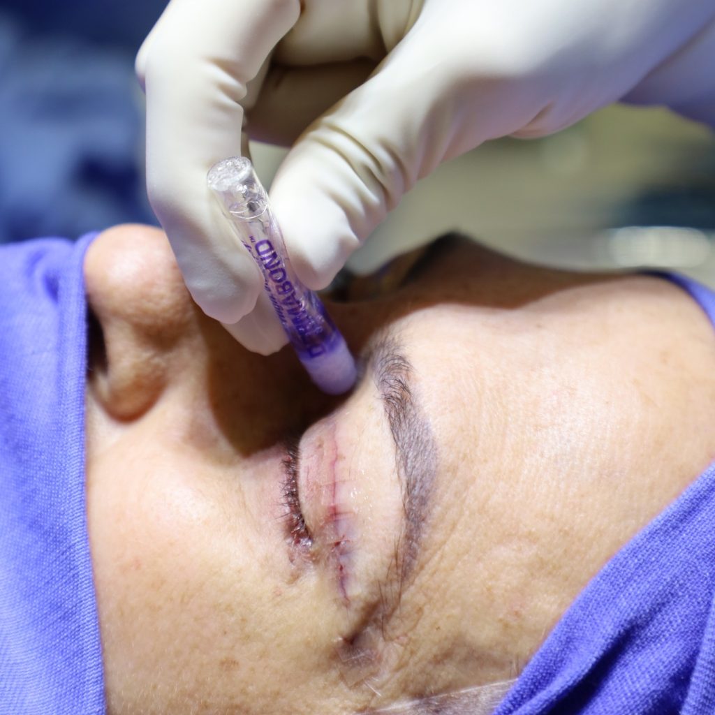 cola tecidual Blefaroplastia