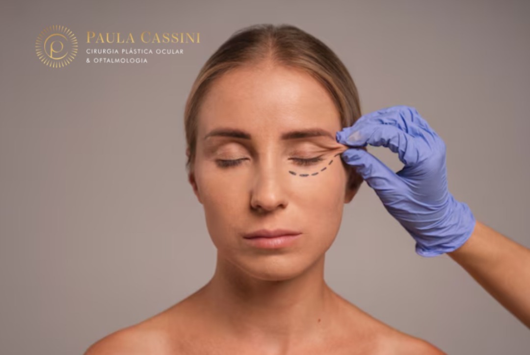 Blefaroplastia sem cirurgia