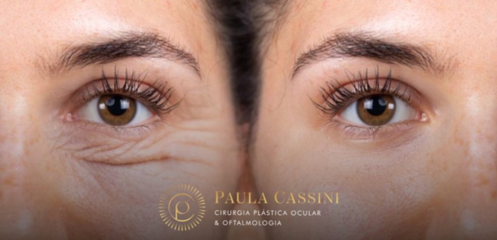 Blefaroplastia e o impacto do estilo de vida no envelhecimento da região periorbital
