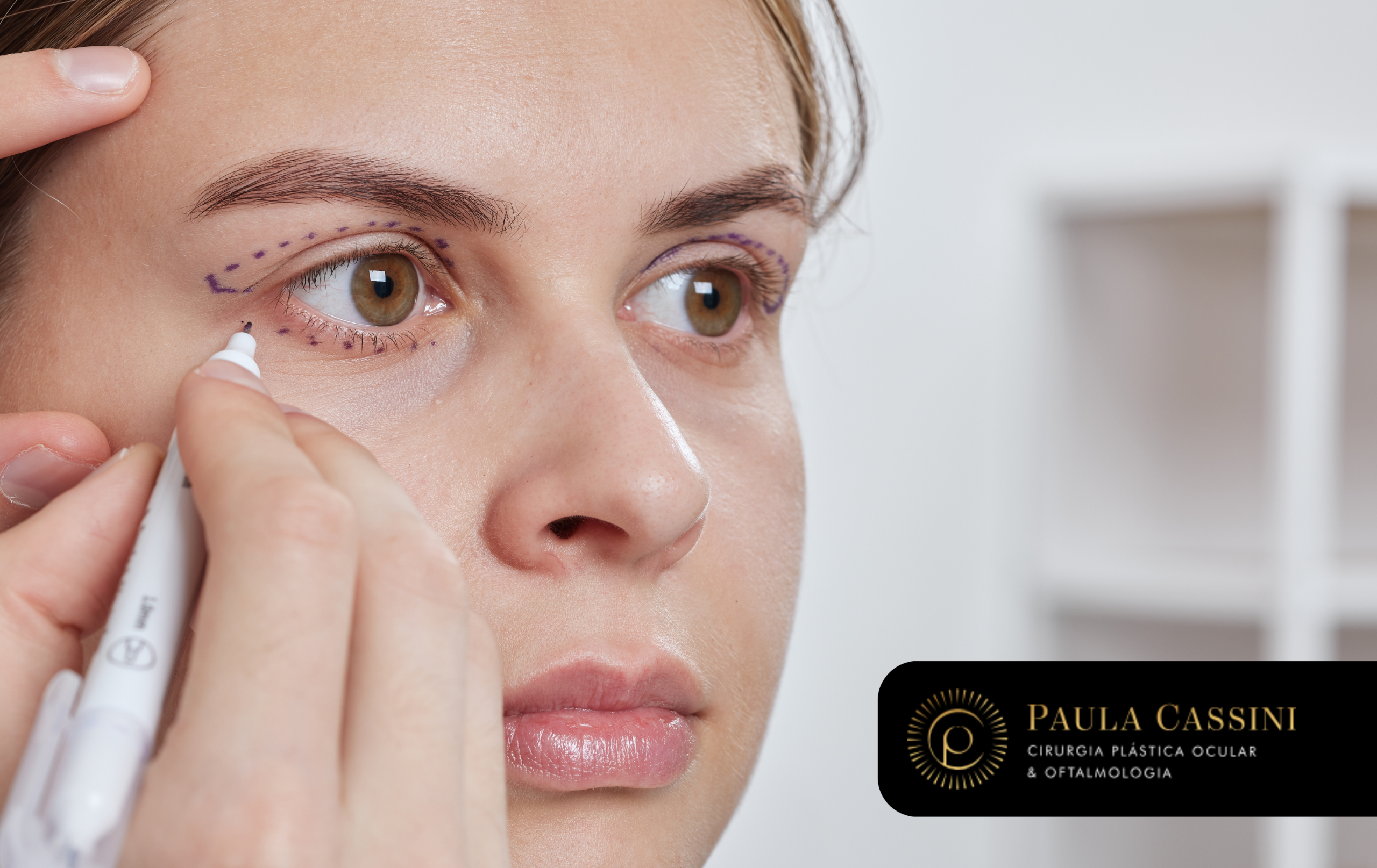 Estética ocular não é apenas uma questão visual, mas também funcional e anatômica. Dê preferência a profissionais com formação em medicina e especializações voltadas à cirurgia plástica ocular, dermatologia ou medicina estética com foco em procedimentos na área dos olhos.